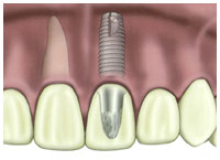 Dental Implants Orange County