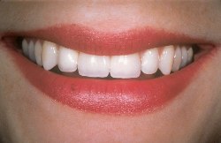 implant dentistry at Lake Forest Dental